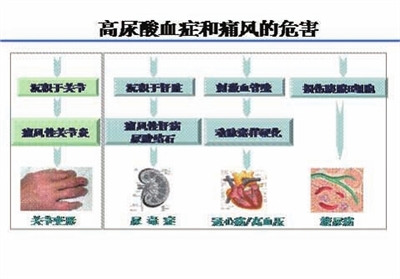 4·20全民关注痛风日 认识痛风   痛风:是一种单钠尿酸盐沉积于骨关节